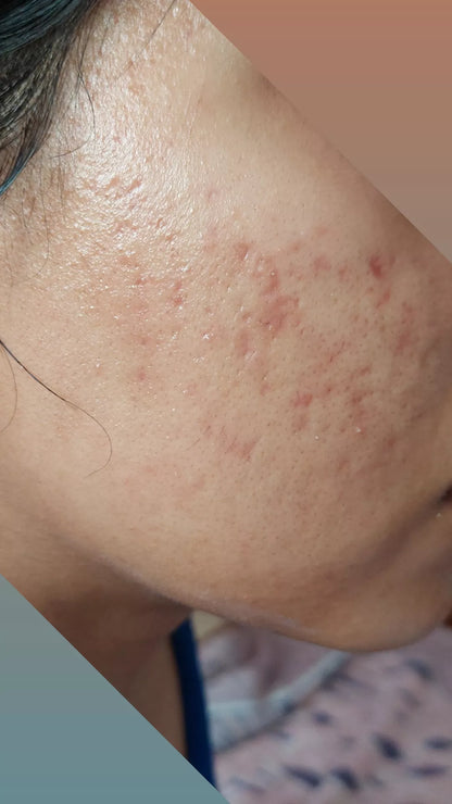 Anti Acne Serum with Tee Tree Extract 30ml