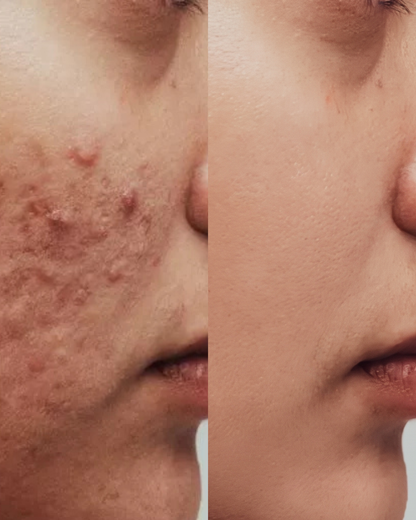 Anti Acne Glass Skin Deal